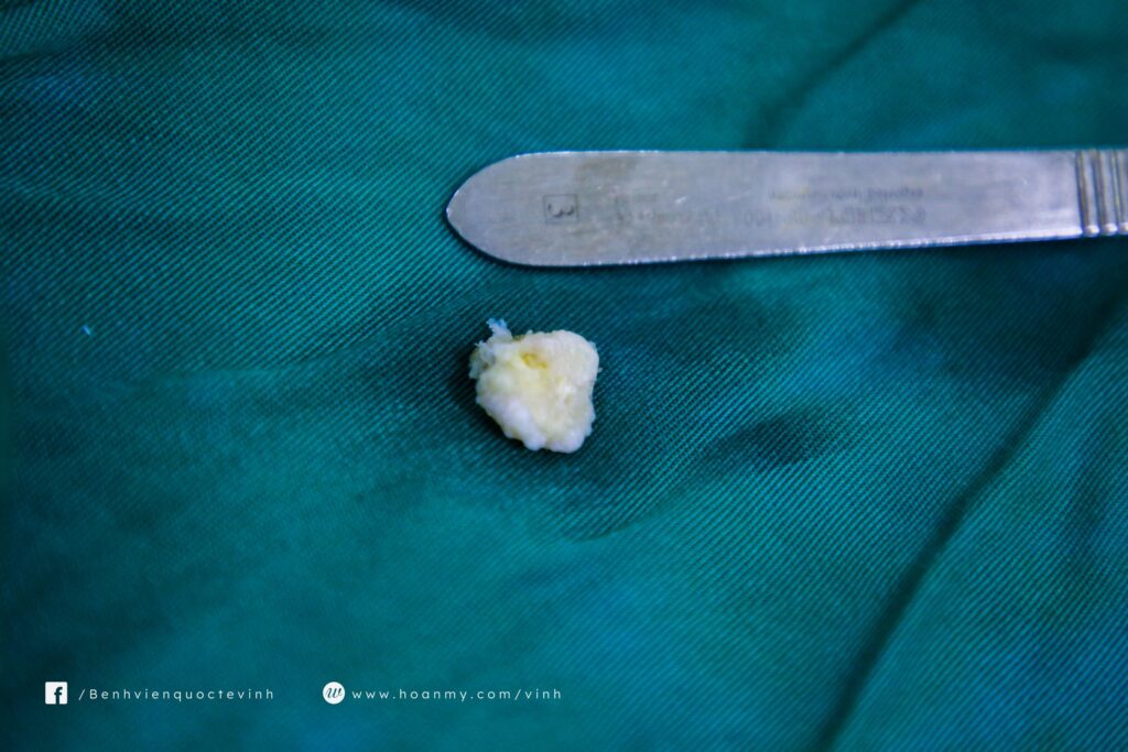 Mảnh sụn gây kẹt gối