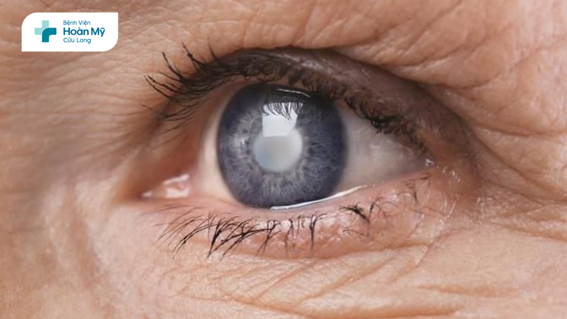 Đục thủy tinh thể: Nguyên nhân, dấu hiệu nhận biết và cách điều trị hiệu quả
