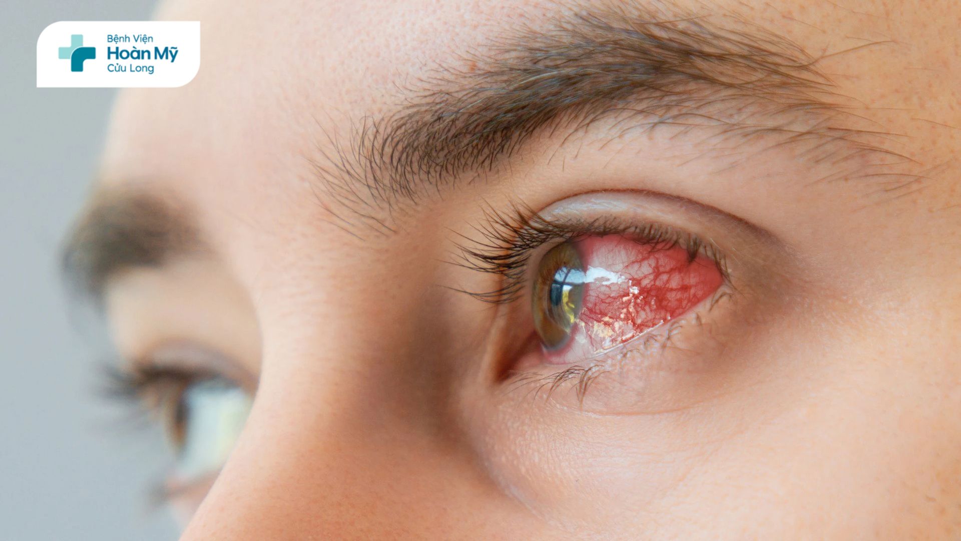 Viêm kết mạc dị ứng: Dấu hiệu nhận biết, biến chứng và cách xử trí đúng