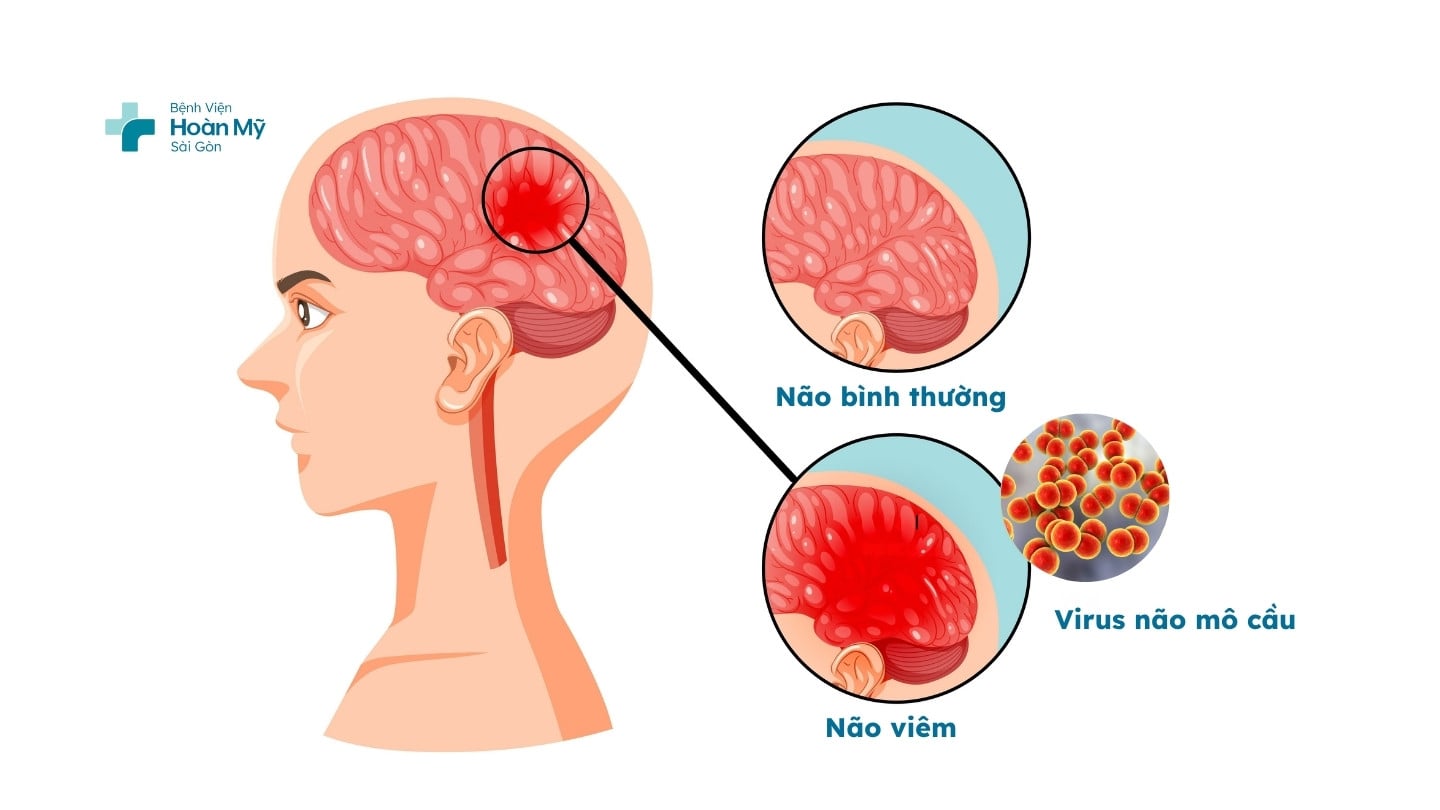 Vắc xin não mô cầu – nên tiêm loại nào để phòng bệnh hiệu quả?