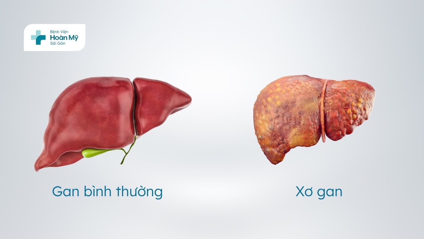 Vì sao nên tiêm phòng viêm gan B?